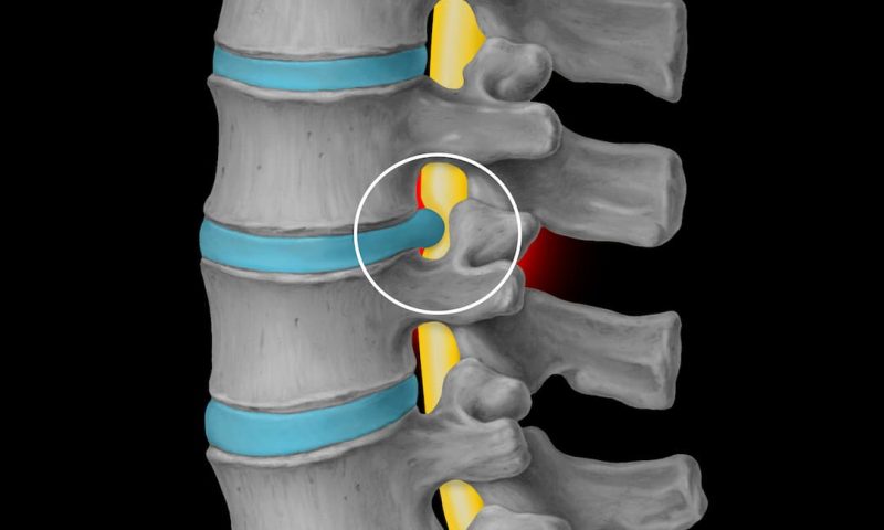 porcentaje de incapacidad por hernia de disco l5-s1 porcentaje de incapacidad por hernia de disco l5-s1