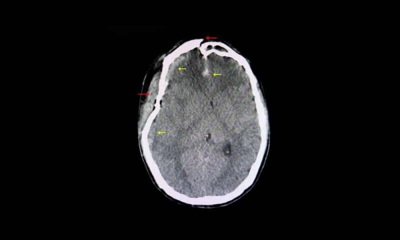 Brain Swelling After a Car Accident | Car Accident Head Injury Statistics | LaBovick Law Group of West Palm Beach, Florida