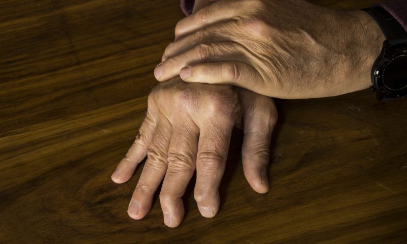 The hands of a male with Psoriatic Arthritis psoriatic arthritis